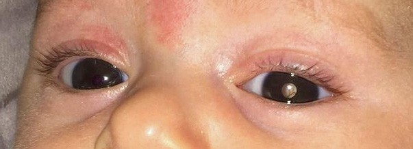 Retinoblastoma