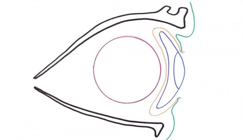 Orbital implant